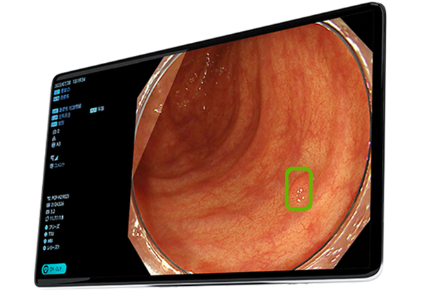 大腸ポリープ検出支援システム