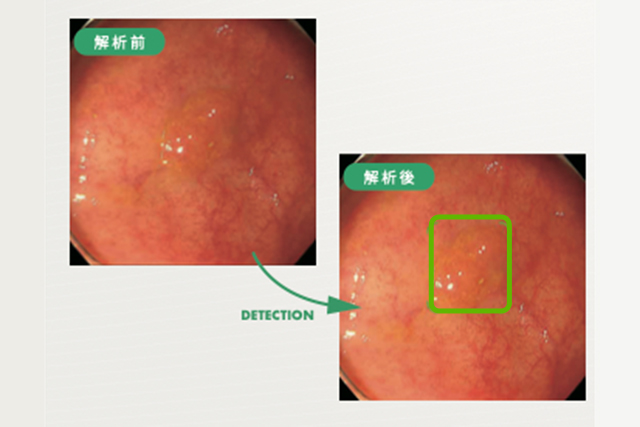 大腸ポリープ検出支援システム